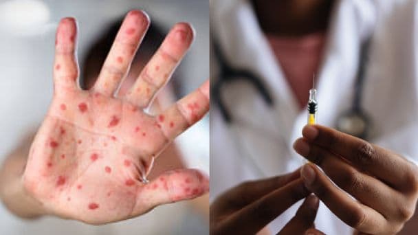 Experto de la OMS dice que la viruela del mono no tardará en ser pandemia