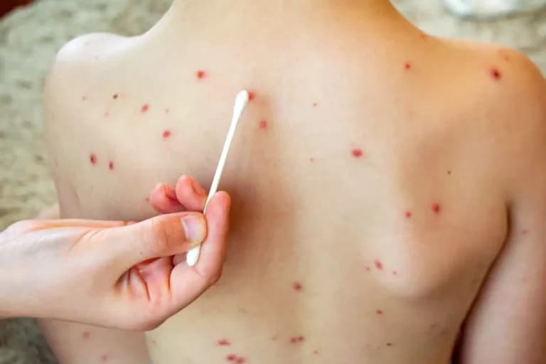 Sanidad confirma un brote de sarampión en La Palma con dos menores y un sanitario afectados