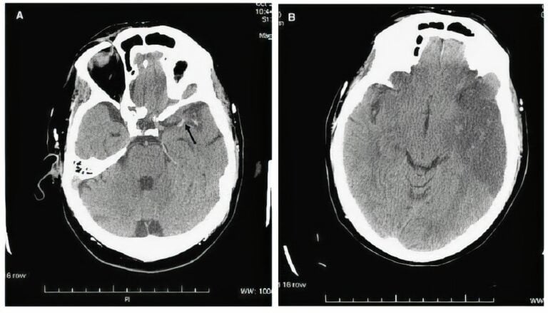 El tiempo es cerebro: cómo reaccionar a un ictus ya