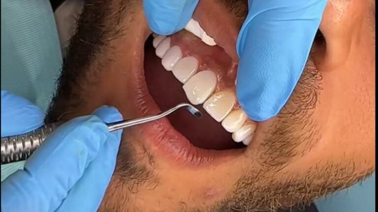 Dentistas advierten: hacerse carillas dentales en Marruecos no es un souvenir exótico