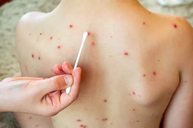 Sanidad confirma un brote de sarampión en La Palma con dos menores y un sanitario afectados