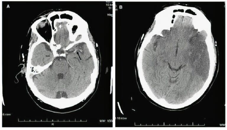 El Servicio Canario de la Salud registra 2.678 ingresos por ictus en 2024 y refuerza la atención especializada con el programa Código Ictus
