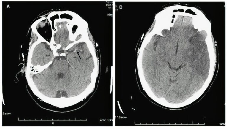 El Servicio Canario de la Salud registra 2.678 ingresos por ictus en 2024 y refuerza la atención especializada con el programa Código Ictus